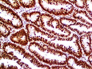 IHC of Retinoblastoma on an FFPE Colon Carcinoma Tissue